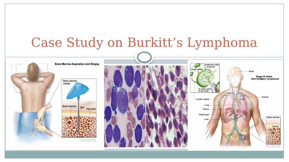 Case Study on Burkitt’s Lymphoma Desklib