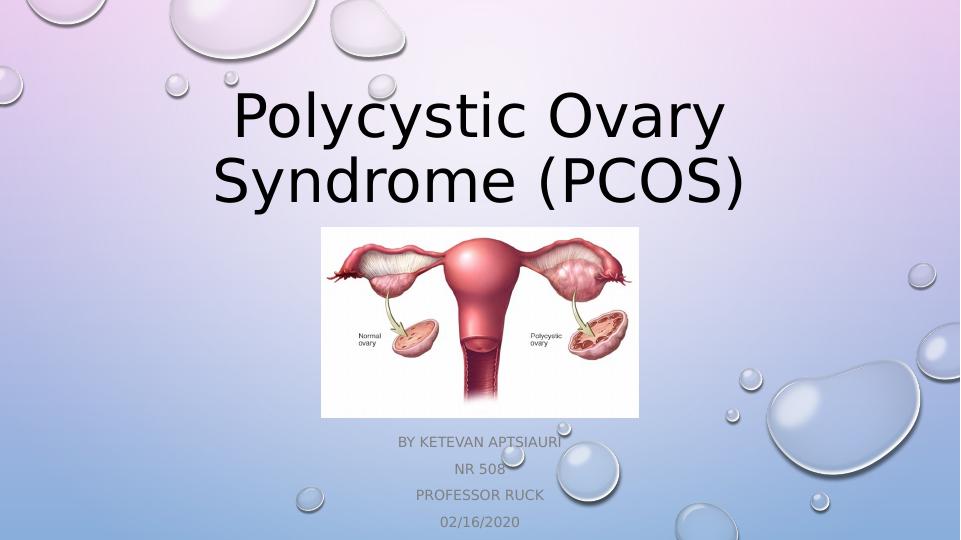 Polycystic Ovary Syndrome (PCOS).