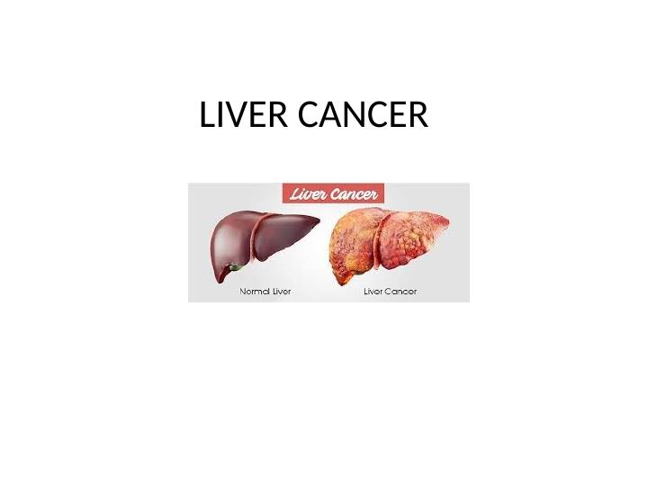 Liver Cancer: Signs and Symptoms_1
